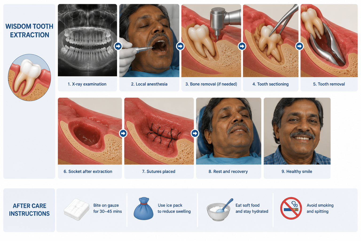 Wisdom tooth care